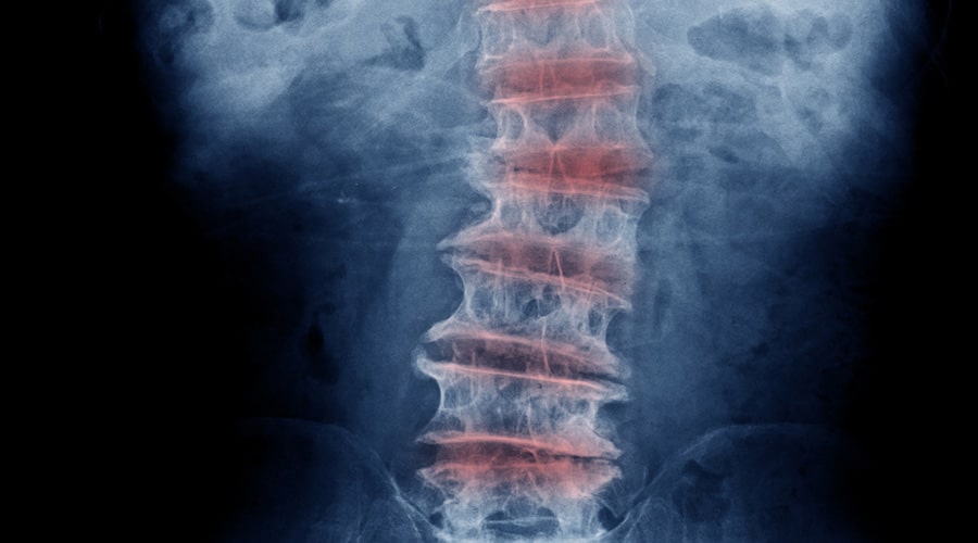 Spinal Disk Problems