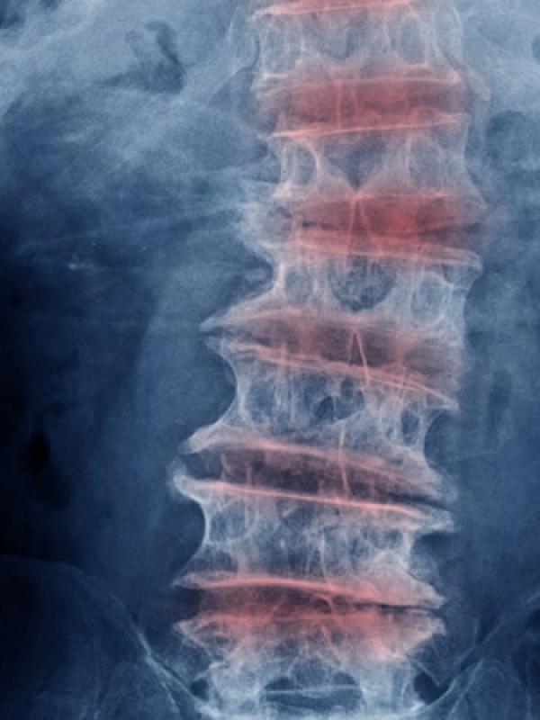 Spinal Disk Problems