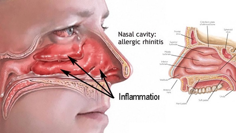 Catarrh