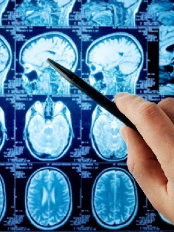 Brain Cancer