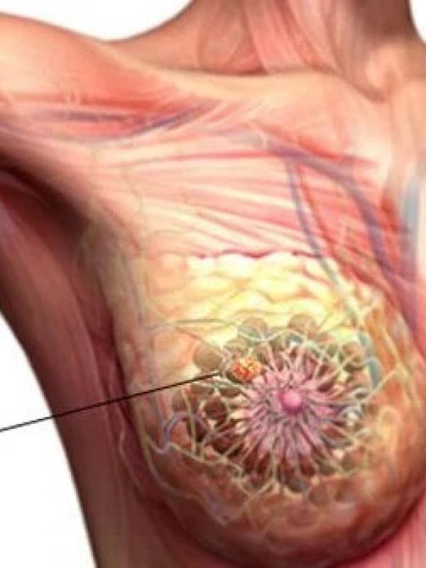 Breast Cancer