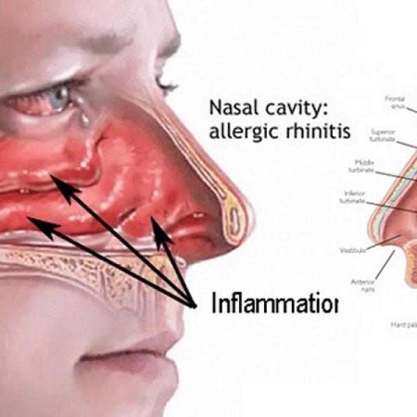 Catarrh